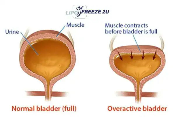 diagram of overactive bladder treatment Walham Green