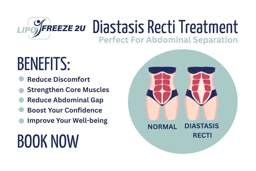 Benefits of body toning treatment Walham Green for Diastasis recti