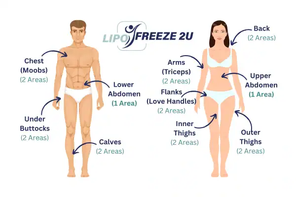 Areas you can have fat freezing treatment Walham Green