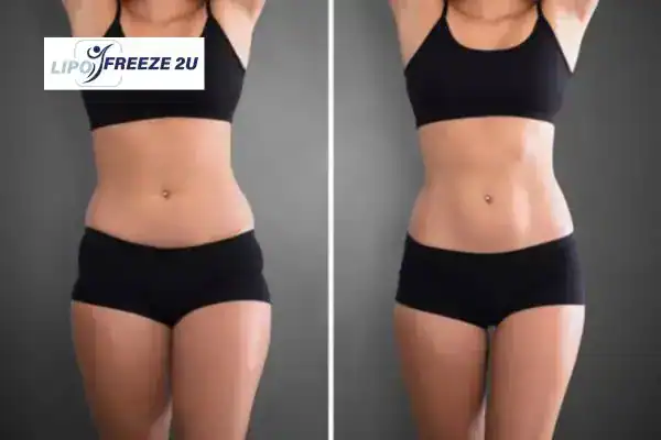 How Can LIPO FREEZE 2U Support Your Post-Pregnancy Body Recovery Walham Green?