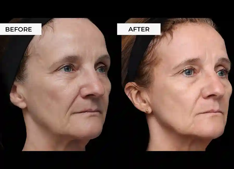 How Many RF Microneedling Sessions Will You Need to See a Difference Walham Green?