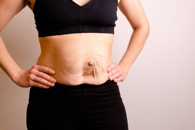 Is Surgery Really the Only Way to Repair Diastasis Recti Walham Green?