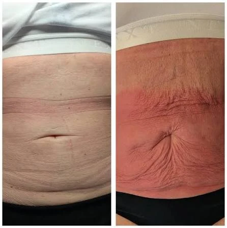 How Does RF Microneedling Improve Crepey, Thin and Uneven Skin Texture Walham Green?