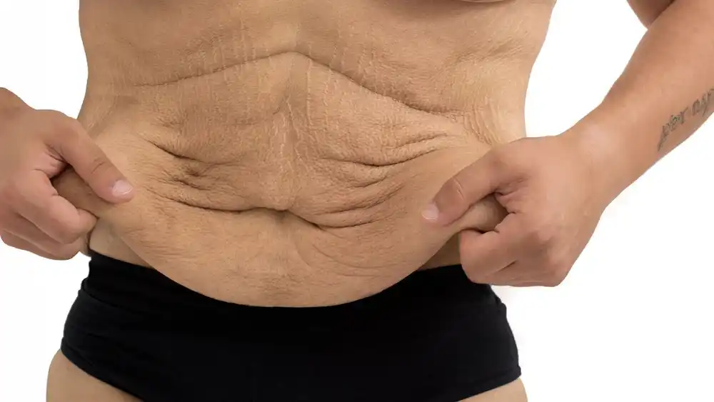 RF Microneedling for Loose Skin: How Can It Help Tighten and Reshape the Skin Walham Green?